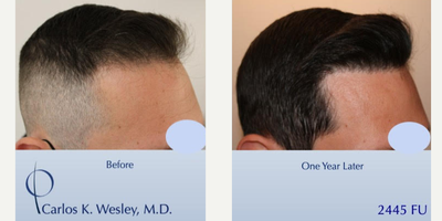 Patient treated with FUE Hair Transplant, Hair Loss Treatment, Hair Transplant - This 43-year-old man underwent a follicular unit extraction (FUE) session with Dr. Carlos K. Wesley in which a total of 2445 grafts were placed.