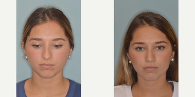 18-24 year old woman treated with Rhinoplasty - Patient with concerns of a droopy tip, hanging columella, and hump. Primary rhinoplasty techniques included hump reduction, osteotomies, caudal septal extension graft and tip onlay graft.
