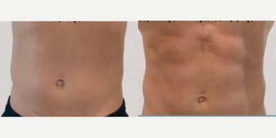 Man treated with Emsculpt - Emsculpt Neo is a medical device designed for non-invasive body sculpting. It utilizes a combination of two technologies: radiofrequency (RF) and high-intensity focused electromagnetic (HIFEM) energy. This dual-action approach aims to provide a comprehensive solution, addressing both fat reduction and muscle enhancement.