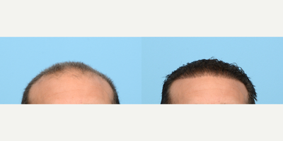 45-54 year old man treated with FUE Hair Transplant, Hair Transplant, Hair Loss Treatment, PRP for Hair Loss - This 53-year-old patient was experiencing recession in the front of his scalp and overall thinning. Dr. Wise performed an FUE hair transplant where he strategically placed 3,050 grafts in zones 1 and 2. In addition, Platelet Rich Plasma therapy was done to expedite healing and strengthen the follicles. The results are shown one year post-op.