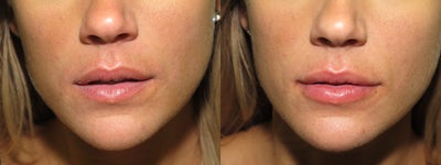 Lip enhancement / augmentation with filler - in this case Juvederm - lip augmentation with Juvederm
