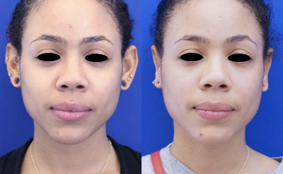 25-34 year old woman treated with Ear Surgery - This lady dislikes the enlarged concha bowl or the middle portion of the ear. She undergoes In-office otoplasty under local anesthesia to pin back the enlarged portion for a more natural look.