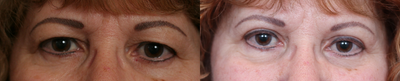 55-64 year old woman treated with Eyelid Surgery - Bilateral upper blepharoplasty