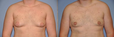 Gynecomastia- Male Breast Reduction - Male Breast Reduction