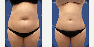 Woman treated with Vaser Liposuction, Renuvion - Upper body vaserlipo and Helium Plasma Energy (J Plasma) Postop 6 months laterRenuvion J Plasma is a technology that leverages from helium gas plasma energy. It is used for skin tightening on the bodyThe Helium plasma focuses RF energy for a great control of tissue effect, enabling an precision and virtually eliminating unintended tissue trauma.In this procedure, we used it in combination with Vaserlipo to eliminate excess fat and loose skin.