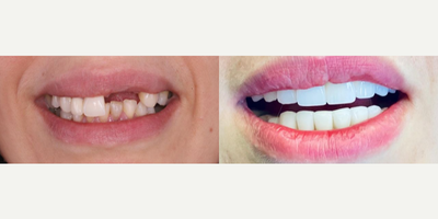 Woman treated with Dental Bridge - Zircon Bridge