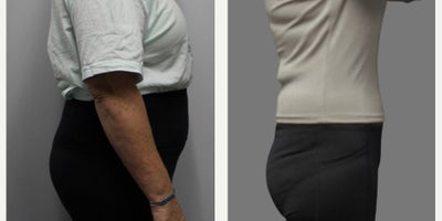 55-64 year old woman treated with Tirzepatide for Weight Loss - 60 year old woman treated with Tirzepatide for Weight Loss (53lbs lost)