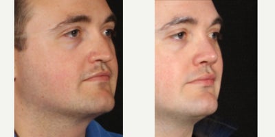 25-34 year old man treated with Rhinoplasty - One month ago our patient underwent a rhinoplasty to straighten the bridge and rotate the tip of his nose. We used piezo technology to swing the bridge towards the midline with less bruising and swelling. So far the symmetry is improved and he is breathing a lot better. We are so pleased with the progress and appreciate him allowing us to share his photos.