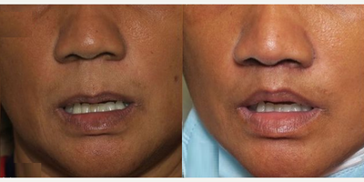 Woman treated with Lip Lift - Woman treated with Lip Lift