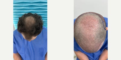 55-64 year old man treated with DHI Hair Transplant - This case documents the scalp condition 1 day after a DHI hair transplant performed at FullFace Clinic.At this early post-operative stage, the implanted grafts are clearly visible, allowing an objective assessment of hairline reconstruction, graft distribution, and implantation precision. Special attention was given to restoring coverage in areas affected by advanced hair thinning, while maintaining a natural and age-appropriate hairline design.The procedure was performed using the DHI (Direct Hair Implantation) technique, which allows for direct placement of grafts without creating pre-made incisions. This approach enables precise control over angle, depth, and direction of each graft, which is particularly important in patients with mature hair loss patterns.Mild redness and swelling in the recipient area are normal and expected at this stage of healing. The donor area shows clean extraction points with no signs of overharvesting, reflecting a conservative and medically responsible approach.This case represents the immediate post-operative phase of the hair restoration process. Final density and cosmetic outcomes are typically assessed between 9 and 12 months after the procedure, once full hair growth has occurred.