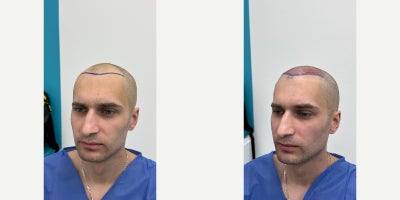 35-44 year old man treated with DHI Hair Transplant - This case shows the scalp condition 1 day after a DHI hair transplant procedure performed at FullFace Clinic.At this early post-operative stage, the implanted grafts are clearly visible, allowing for an objective evaluation of hairline design, graft distribution, and implantation accuracy. The procedure focused primarily on rebuilding the frontal hairline and frontal scalp area, with careful attention to maintaining a natural, age-appropriate shape.The DHI (Direct Hair Implantation) technique was used, which allows for direct placement of hair follicles without creating pre-made recipient incisions. This method provides precise control over the angle, depth, and direction of each graft, which is essential for achieving a natural-looking result, especially in the frontal zone.Mild redness and swelling in the recipient area are normal and expected at this stage of healing. The donor area demonstrates clean extraction points and an even harvesting pattern, reflecting a conservative and medically responsible approach.This documentation represents the immediate post-operative phase. Final hair growth and cosmetic results are typically assessed between 9 and 12 months after the procedure, once the full hair growth cycle is complete.