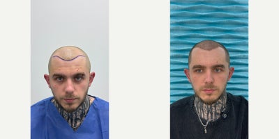 18-24 year old man treated with DHI Hair Transplant - This case shows the scalp condition 1 month after a DHI hair transplant performed at FullFace Clinic in a young male patient aged 1824.At this early stage, the transplanted area has healed well, with normal post-operative shedding (shock loss) beginning, which is an expected part of the hair growth cycle after transplantation. The skin appears calm, with no signs of infection, excessive redness, or scarring.Due to the patients young age, the procedure focused on a conservative and natural hairline design, respecting current facial proportions and anticipating potential future hair loss. The DHI (Direct Hair Implantation) technique was used to ensure precise control over graft angle, direction, and depth, which is essential for achieving a natural result over time.At 1 month post-op, early regrowth may start to appear, while density will continue to develop gradually over the coming months. The donor area shows good healing and even extraction, without visible thinning.This stage represents the foundation of the final result. Significant visible improvement is expected between months 6 and 12 as the transplanted follicles enter their active growth phase.