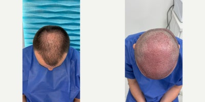 4554 year old man treated with DHI Hair Transplant - This case shows the immediate result 1 day after a DHI hair transplant performed at FullFace Clinic.At this early post-operative stage, the implanted grafts are clearly visible, and the newly designed hairline can already be assessed. The placement of grafts follows a natural direction and angle, which is essential for achieving a realistic final outcome once hair growth is complete.The procedure was performed using the DHI (Direct Hair Implantation) technique, allowing precise and controlled implantation without creating pre-made incisions. This approach helps minimize trauma to the scalp and supports faster healing, especially important for patients in the 4554 age group.Mild redness and swelling visible in the recipient area are normal and expected at this stage. The donor area shows good condition with no signs of excessive trauma. The patient tolerated the procedure well and received detailed post-operative instructions for optimal recovery.This case documents the starting point of the hair restoration process, with final results typically evaluated between 9 and 12 months post-op.