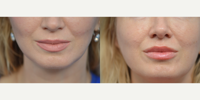 35-44 year old woman treated with Juvederm - 42 year old female concerned with lack of fullness to her lips. Juvederm was injected to her lips the fullness she was seeking.