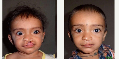 17 or under year old man treated with Cleft Lip And Palate Repair - Cleft lip repair done with Millardss technique under smile train project at Bembde Hospital for Plastic, Cosmetic,Burns & Hand Surgery.