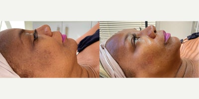 55-64 year old woman treated with Botox, HydraFacial - Botox + HydraFacial