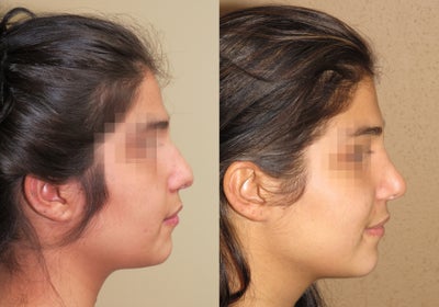 rhinoplasty/nose job before after -
rhinoplast before and after