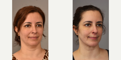 Woman treated with Chin Implant - Woman treated with Neck Lift and Chin Implant. Patient came in wanting a nicely defined jawline and to clean up her neck to achieve a more youthful look.