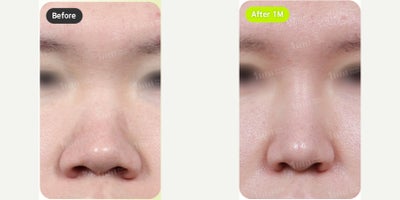 25-34 year old man treated with Alarplasty - 25-34 year old man treated with Alarplasty