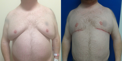 Patient Case #Gynecomastia Patient - Severe gynecomastia requires an extensive procedure that Dr. Khalifeh reserves for advanced gynecomastia cases. In that procedure, the skin and gland and typical axillary roll are surgically excised together, and the nipple is repositioned as a nipple graft. The scarring is not minimal, but patients love the ability to fit in normal shirts and normal clothing, and eventually, the scar fades nicely.