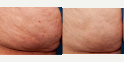 44 year old woman treated with Aveli - Aveli for buttock and thigh cellulite