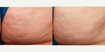 44 year old woman treated with Aveli - Aveli for buttock and thigh cellulite