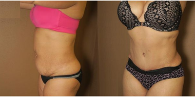 Woman treated with Liposuction - Woman treated with Liposuction