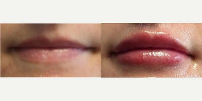 18-24 year old woman treated with Lip Fillers, Juvederm, Volbella, Restylane, Restylane Kysse - Lip augmentation with hyaluronic acid filler (Juvederm, Vollure, Volbella, Voluma, Restylane or Belotero) for balanced natural look & pout