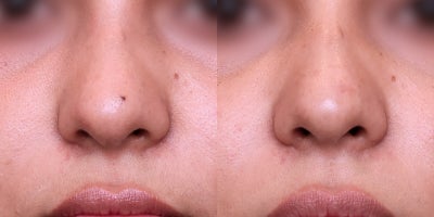 25-34 year old woman treated with Mole Removal (PreciseFX CO2 Laser) - Nasal mole removal with PreciseFX laser. 3 months post-op results showing excellent healing and minimal scarring.