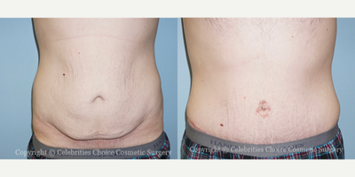 25-34 year old man treated with Male Tummy Tuck - This patient had an extended Abdominoplasty post wheat loss