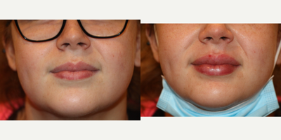 25-34 year old woman treated with Lip Augmentation - This 25 year old woman is shown before and immediately after injection of 1cc of Restylane placed into the upper and lower lip.