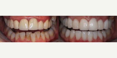 Woman treated with Dental Crown - Woman treated with Dental Crown as well as veneers (20 porcelain restorations), bridges and gum lift for full mouth rehabilitation.