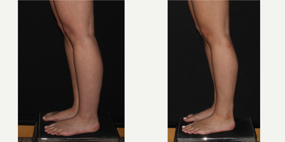 25-34 year old woman treated with Calf Reduction - Before and one year after liposuction to calves, ankles and medial knees.