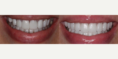 Woman treated with Porcelain Veneers, Dental Crown, Smile Makeover - Smile refresh! Replacing 16 old restorations that this patient had for nearly twenty years with 20 new porcelain veneers and crowns. Patient wanted a healthier more vibrant looking smile. Next phase is restoring back teeth for better flow of the smile. We could not have asked for a more wonderful patientwhat a privilege being part of her transformative journey