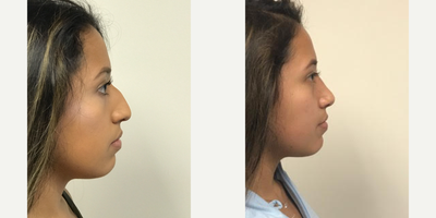 17 year old woman treated with Rhinoplasty - 17 year old female shown before and one month after an open rhinoplasty. The patient desired the dorsum (top) of her to be made less prominent and the tip to be elevated. All procedures done by Frank J. Ferraro, MD