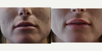 35-44 year old woman treated with Lip Augmentation - Natural results with Juvederm lip enhancement in New Orleans, Metairie