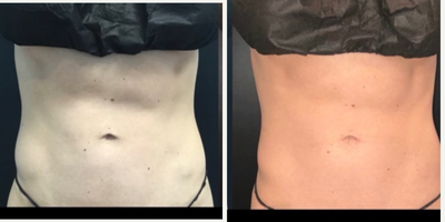 25-34 year old woman treated with truSculpt, Emsculpt - Body Contouring done with TruSculpt ID and Emsculpt NEO
