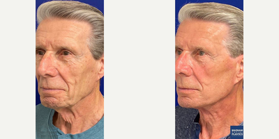 77 year old man treated with Facelift - 77 year old man treated with Facelift
