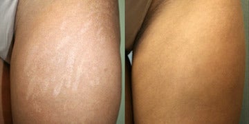 Stretch Marks Treatment