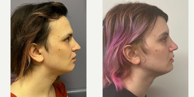 25-34 year old woman treated with Forehead Reduction, Brow Lift, Brow Bone Reduction, Rhinoplasty, Lip Surgery, Genioplasty, Fac - This lady underwent forehead feminization, feminizing rhinoplasty, chin feminization and lip augmentation.