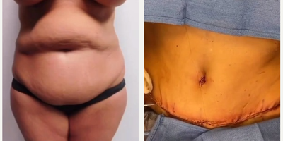 Woman treated with Drainless Tummy Tuck - This patient underwent a drainless tummy tuck procedure