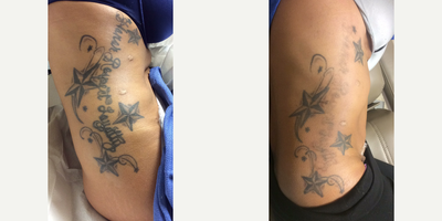 25-34 year old man treated with Tattoo Removal - Partial Tattoo Removal. The patient only wanted a portion of the tattoo removed. These are the results midway through treatment.