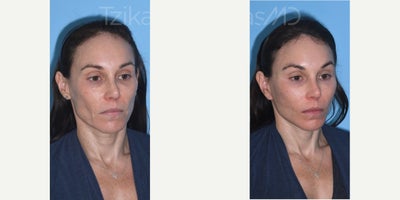 Woman treated with Brow Lift, Fractional Laser, Mini Facelift - Can you guess the secret behind my patients stunning transformation? Temporal Browlift: Lifts and revives those brows, giving the eyes a fresh, youthful look.eCO2 Fractional Laser: Smooths away those pesky lower eyelid wrinkles for a more radiant appearance.Lipografting (Nano/Micro): Have you ever wondered about the magic of nano and micro? Its simple - nano and micro refer to the size of fat graft particles used in the procedure. Theyre like tiny sculptors, adding just the right volume to cheeks and lips for a flawlessly natural contour.Mini Lift: Say hello to a tighter, more defined lower face and jawline!#minifacelift #lipografting #fractional_laser #browlift #tzikasmd #facialplasticsurgeon #plasticsurgerymiami #plasticsurgerydelray