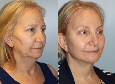 Woman treated with Neck Lift - Woman treated with Neck Lift