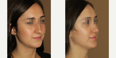 Woman treated with Rhinoplasty - Woman treated with Rhinoplasty