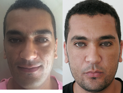 35-44 year old man treated with Facial Fat Injection - Facial Fat injection performed by DR. Ozge Ergun