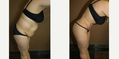45-54 year old woman treated with Liposuction - liposuction and abdominoplasty