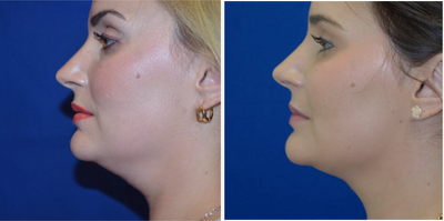25-34 year old woman treated with Kybella - 25-34 year old woman treated with Kybella
