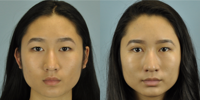 17 or under year old woman treated with Asian Eyelid Surgery - This patient was treated with Boo-Chai eyelid surgery.