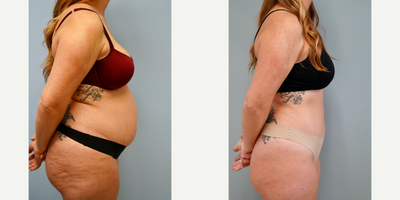 25-34 year old woman treated with Tummy Tuck - Full abdominoplasty with flank liposuction